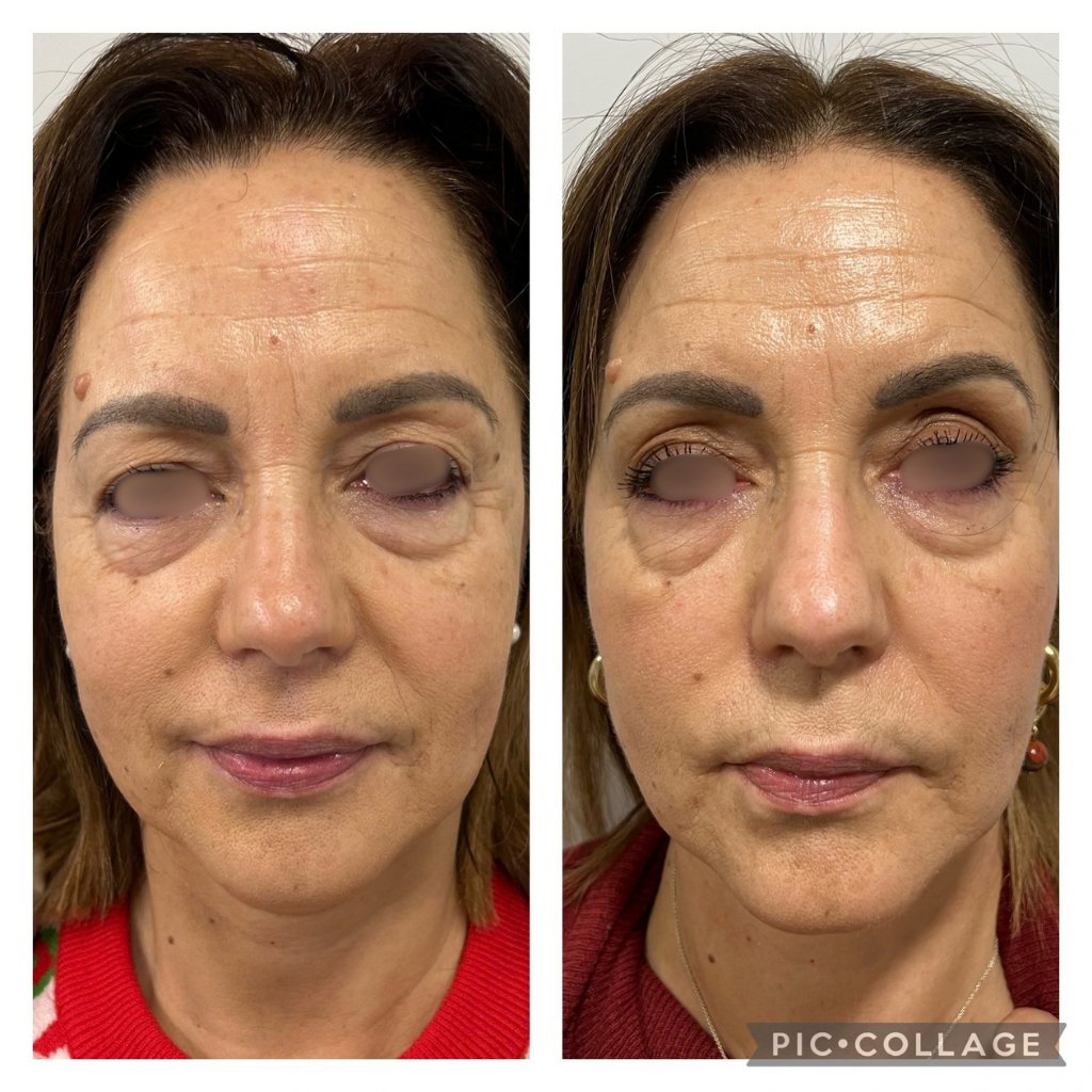 HIFU — antes e depois (caso 10)