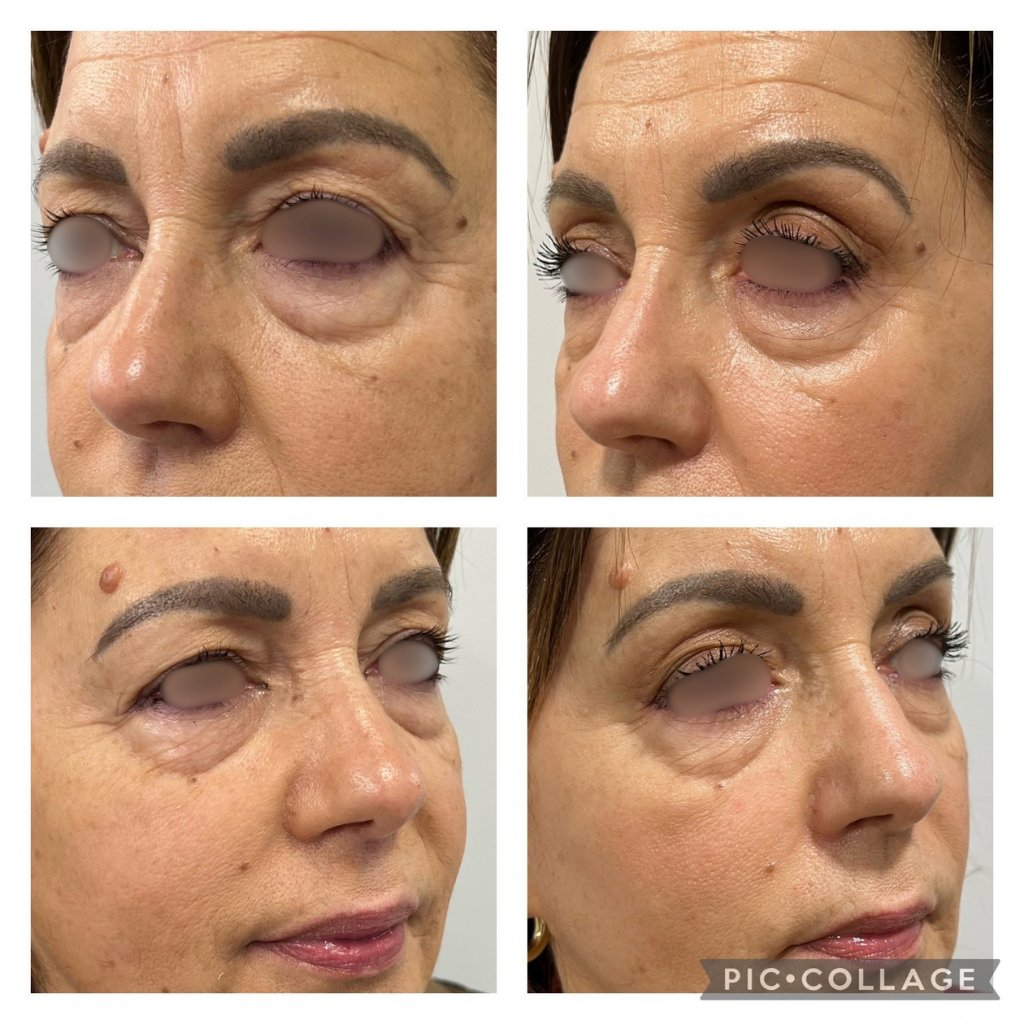 HIFU — antes e depois (caso 11)