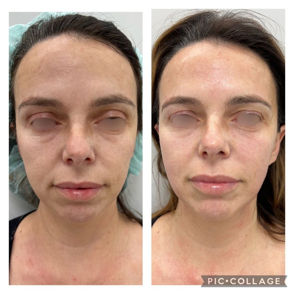 HIFU — antes e depois (caso 12)