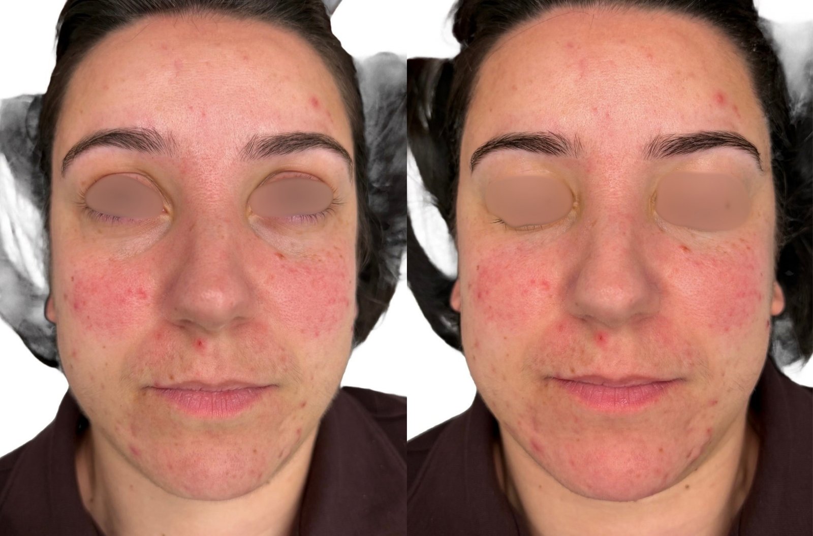 HIFU — antes e depois (caso 13)