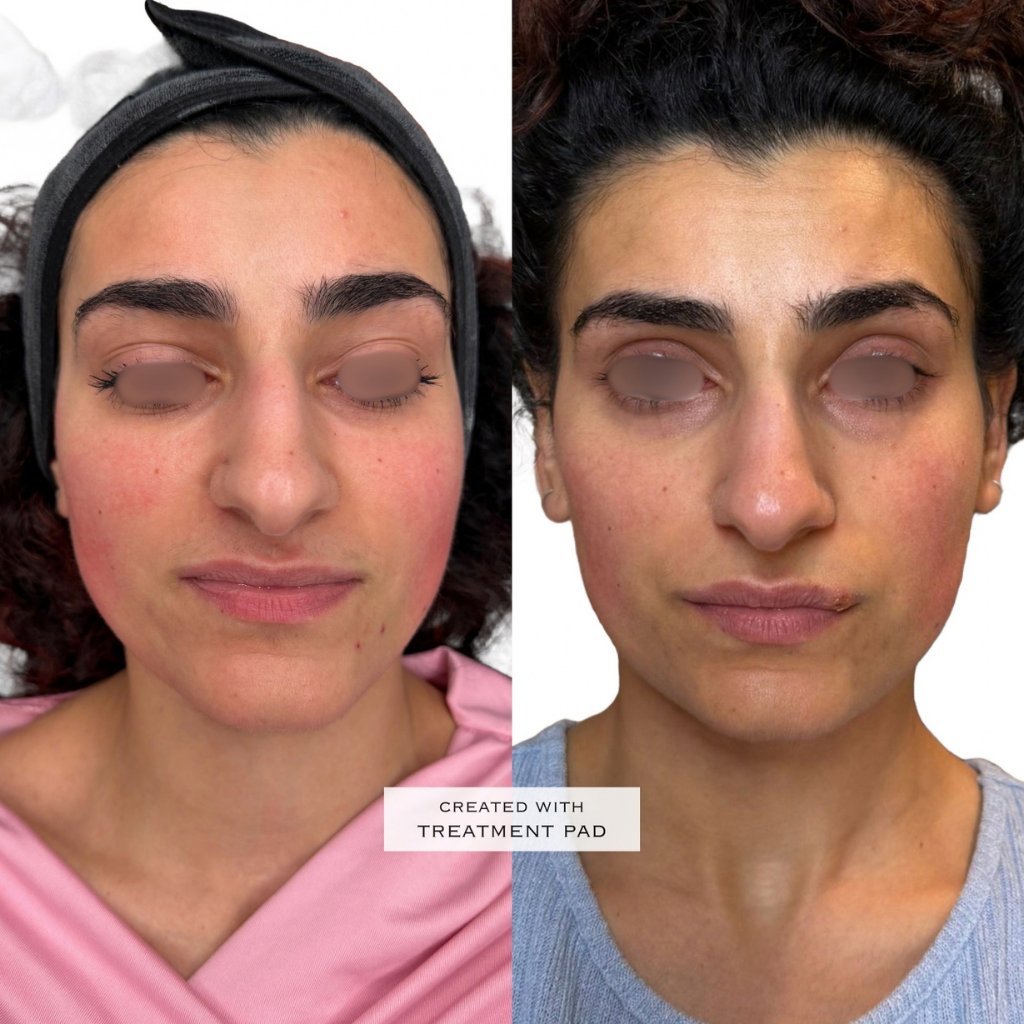 HIFU — antes e depois (caso 14)