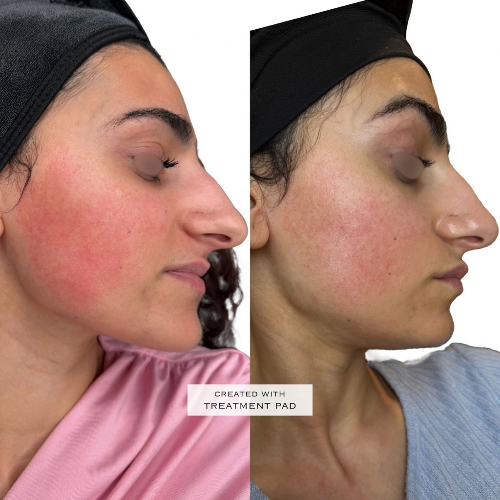 HIFU — antes e depois (caso 15)