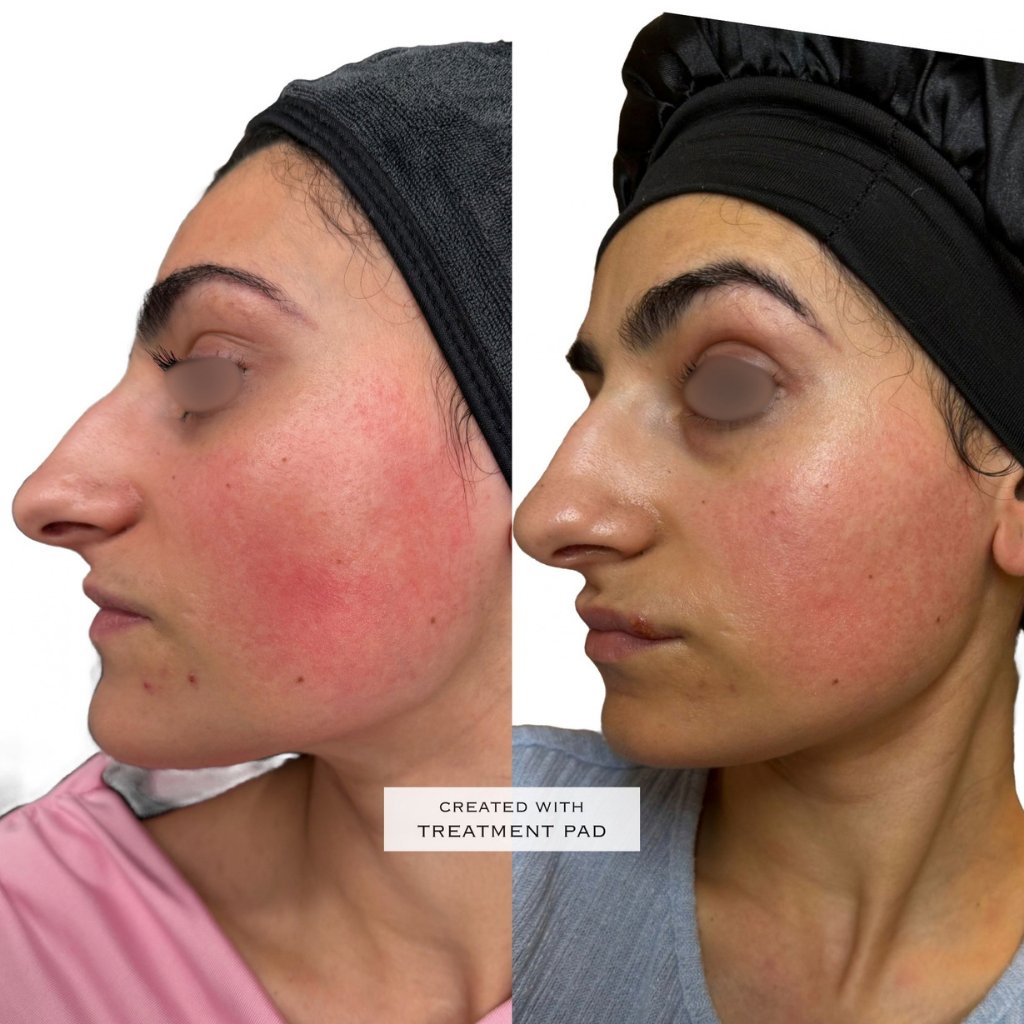 HIFU — antes e depois (caso 16)