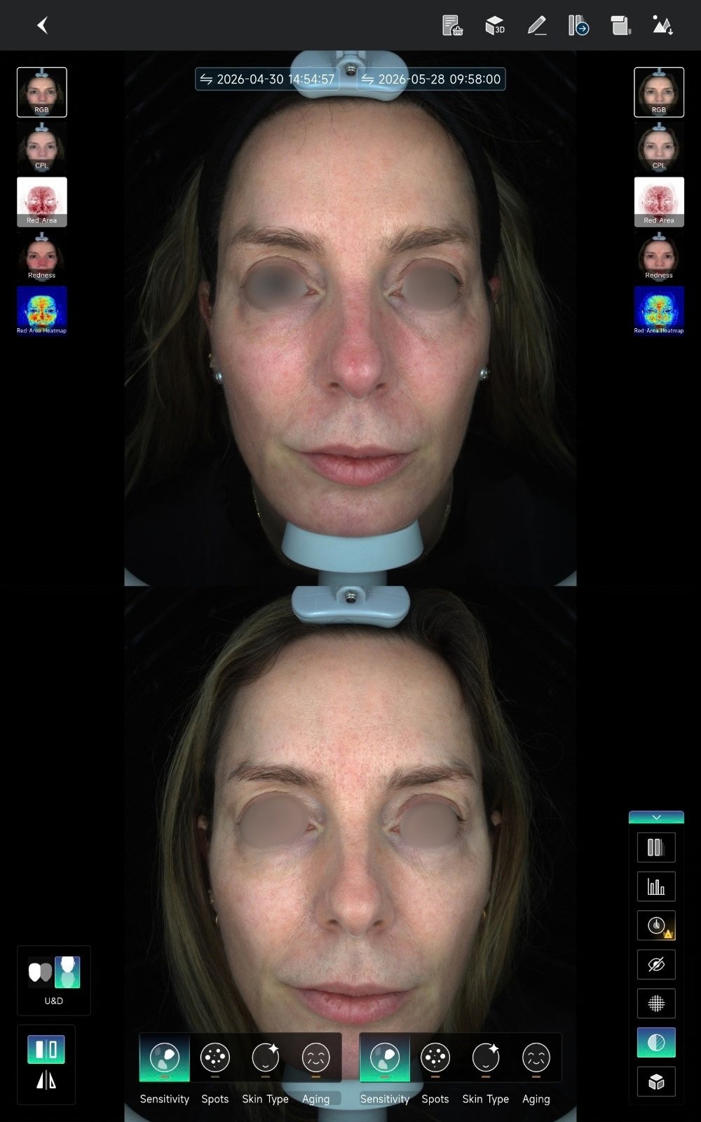 HIFU — antes e depois (caso 17)