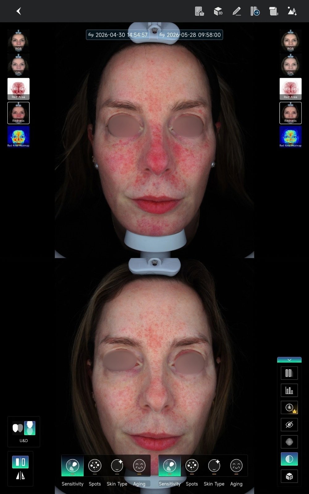 HIFU — antes e depois (caso 18)