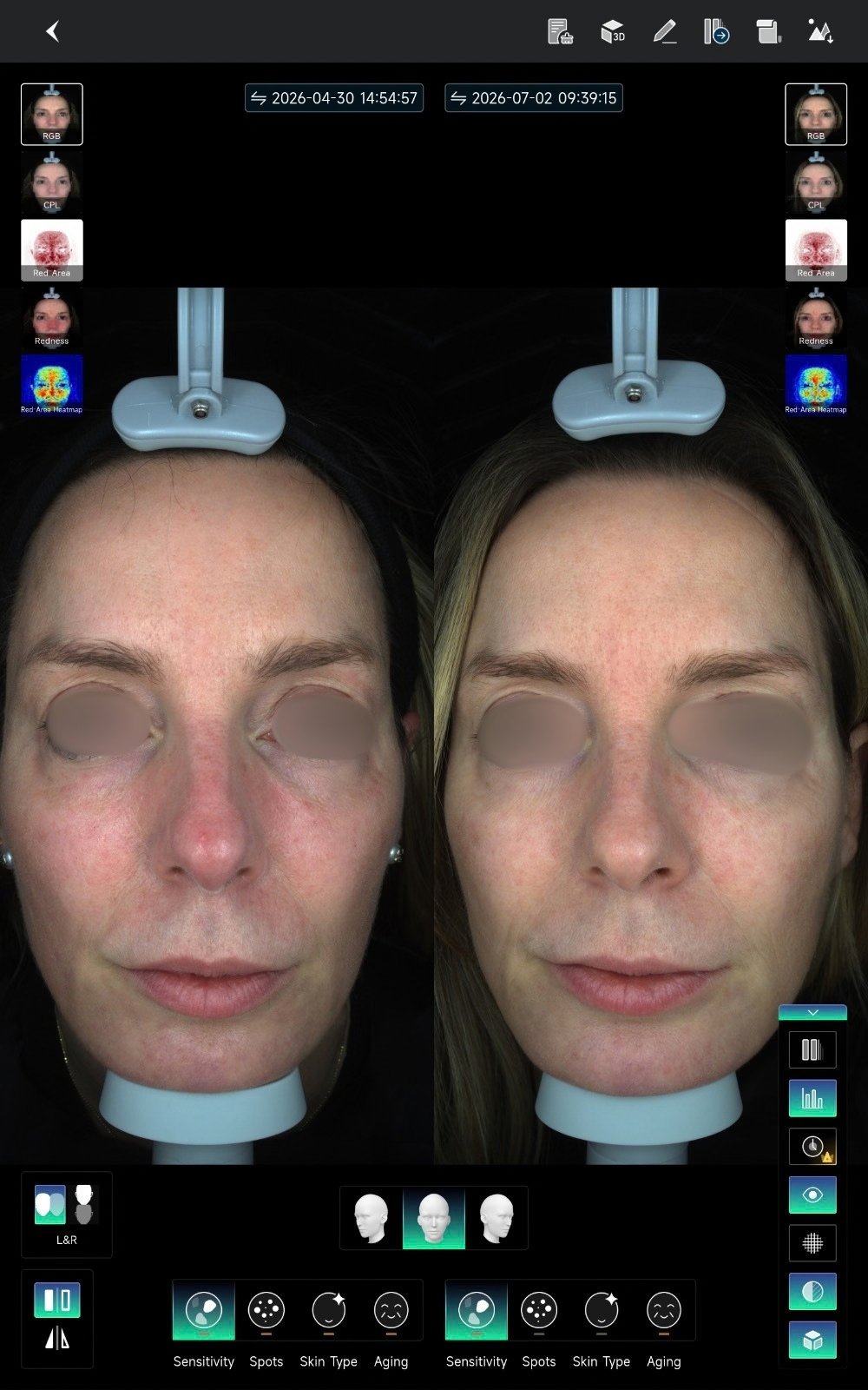 HIFU — antes e depois (caso 19)