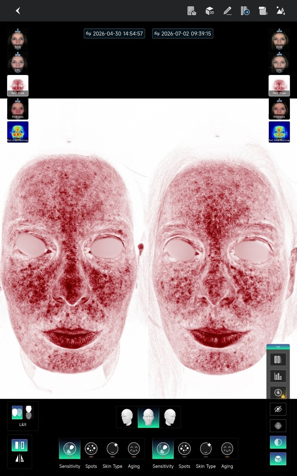 HIFU — antes e depois (caso 20)