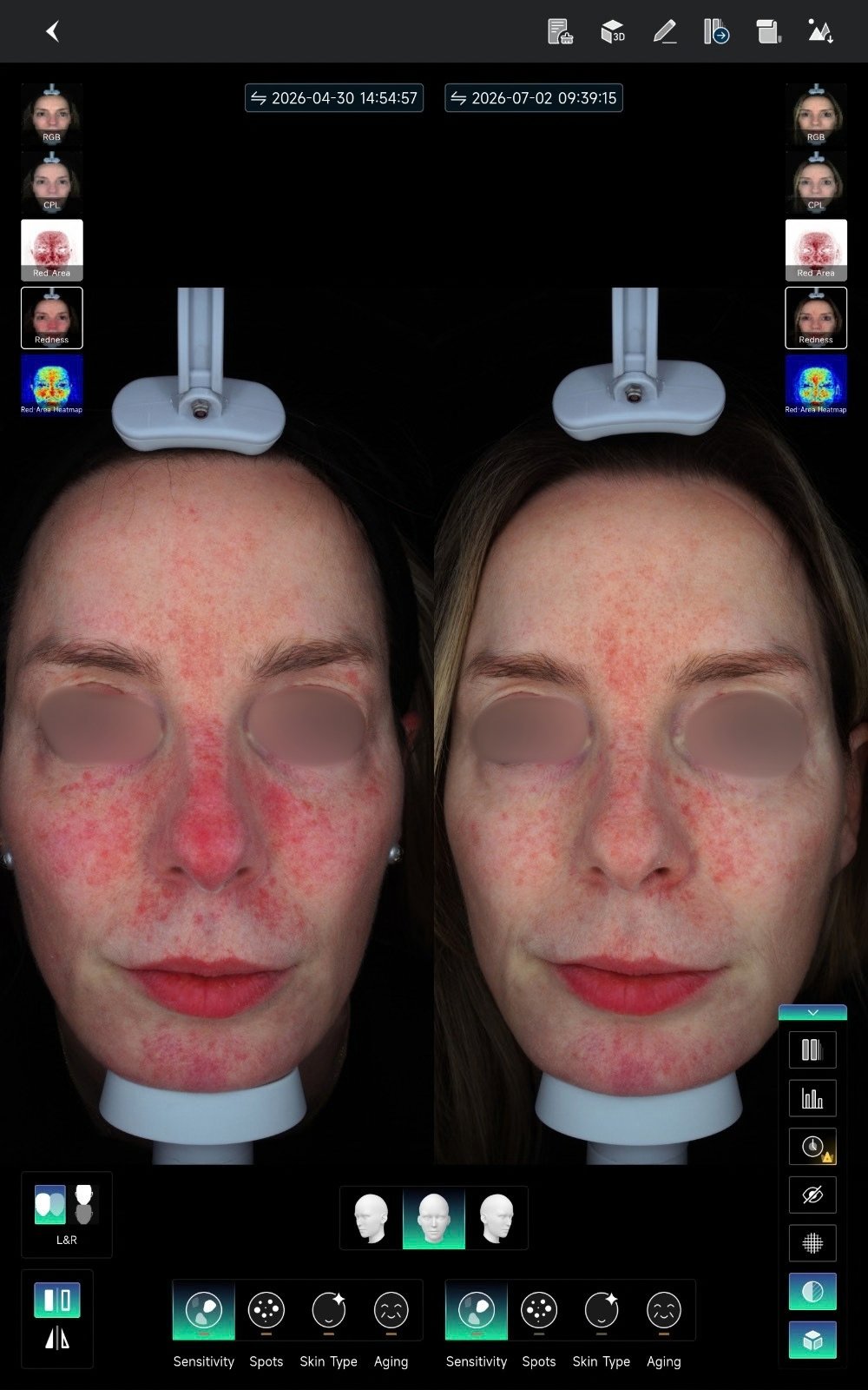 HIFU — antes e depois (caso 21)