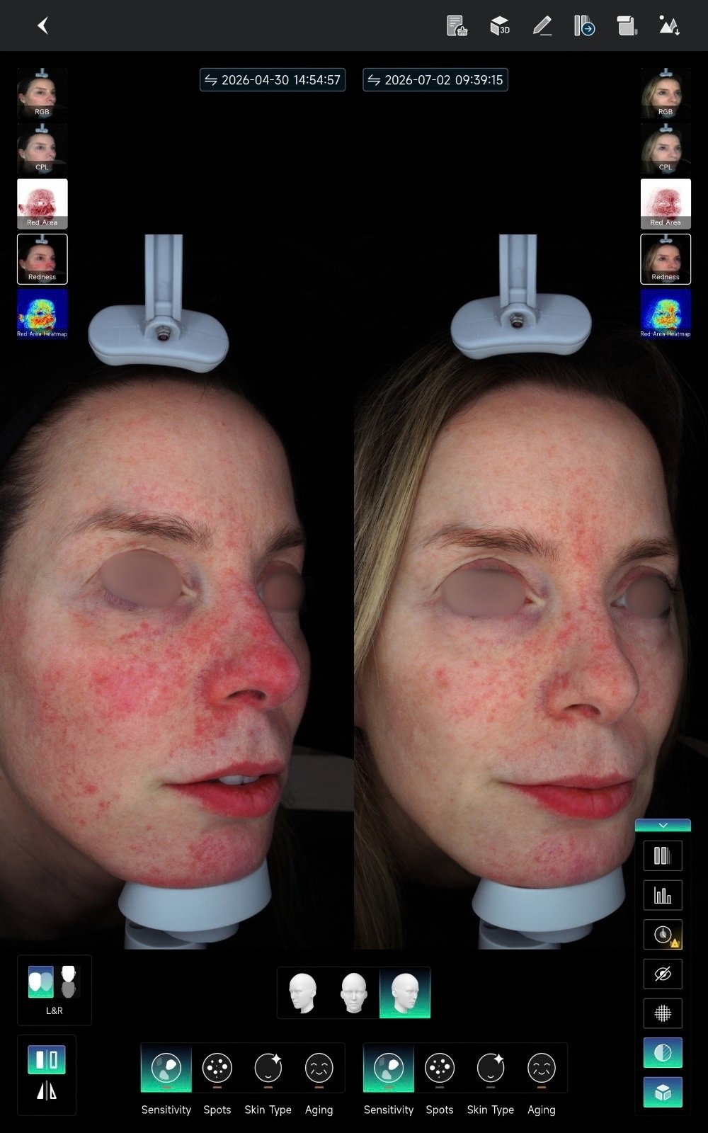 HIFU — antes e depois (caso 22)