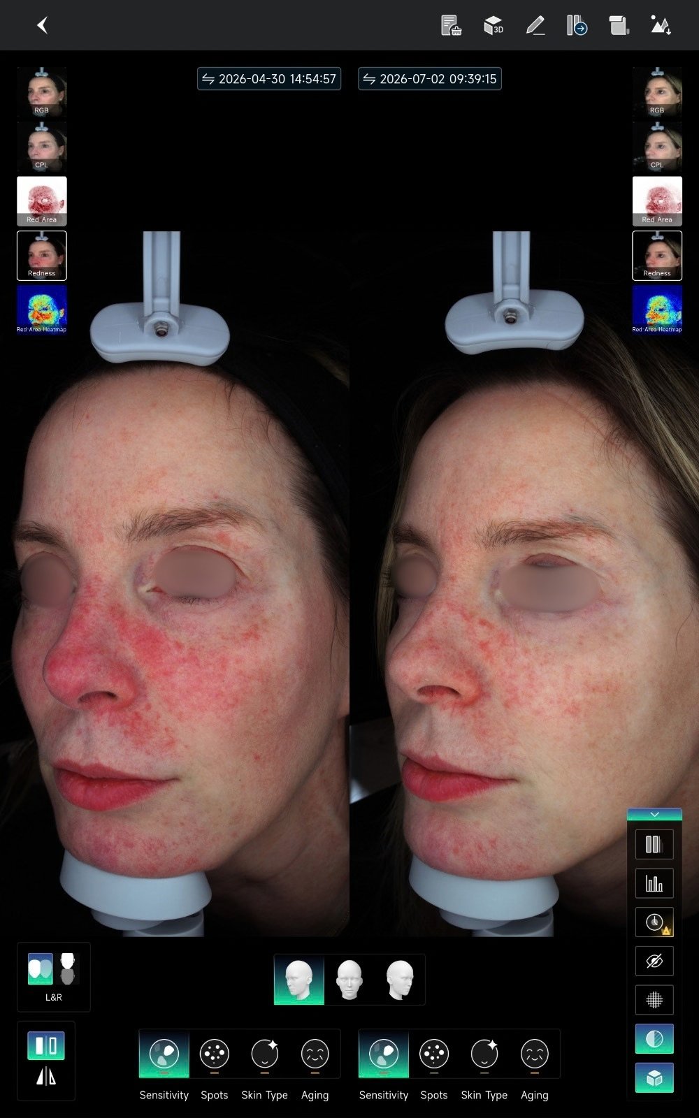 HIFU — antes e depois (caso 23)