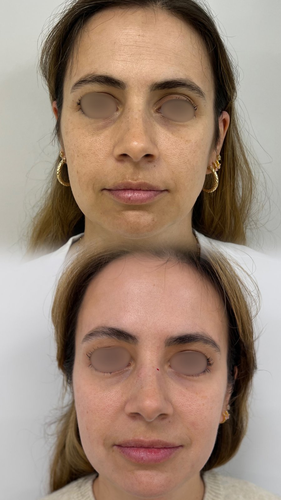 HIFU — antes e depois (caso 24)