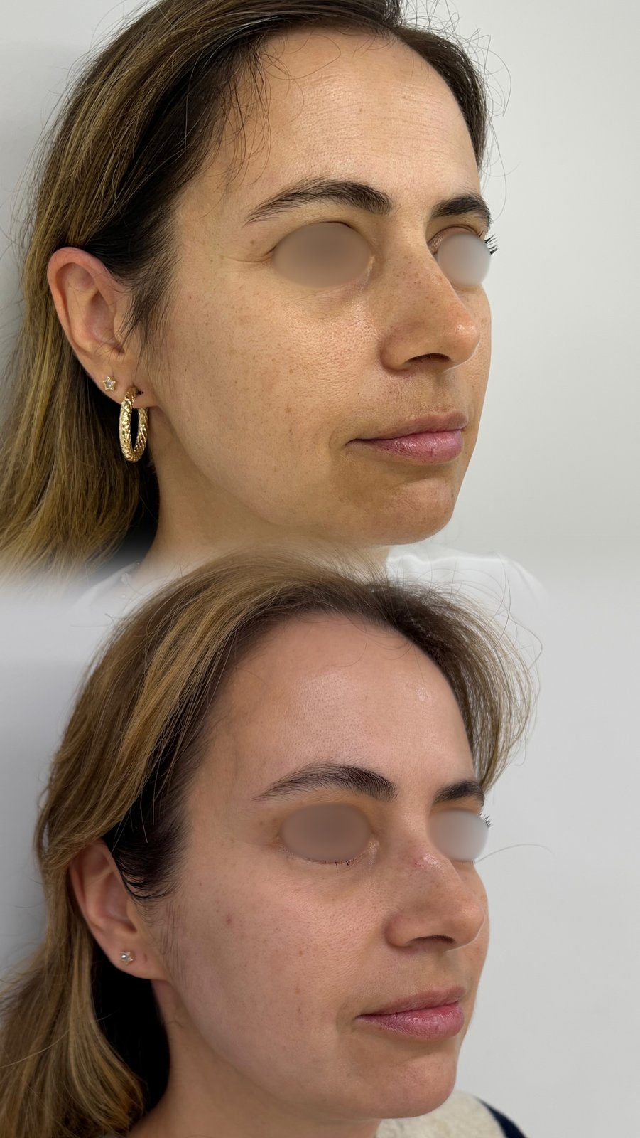 HIFU — antes e depois (caso 25)