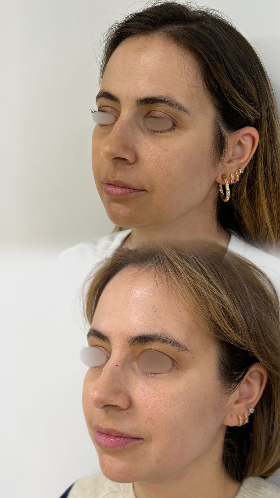 HIFU — antes e depois (caso 26)