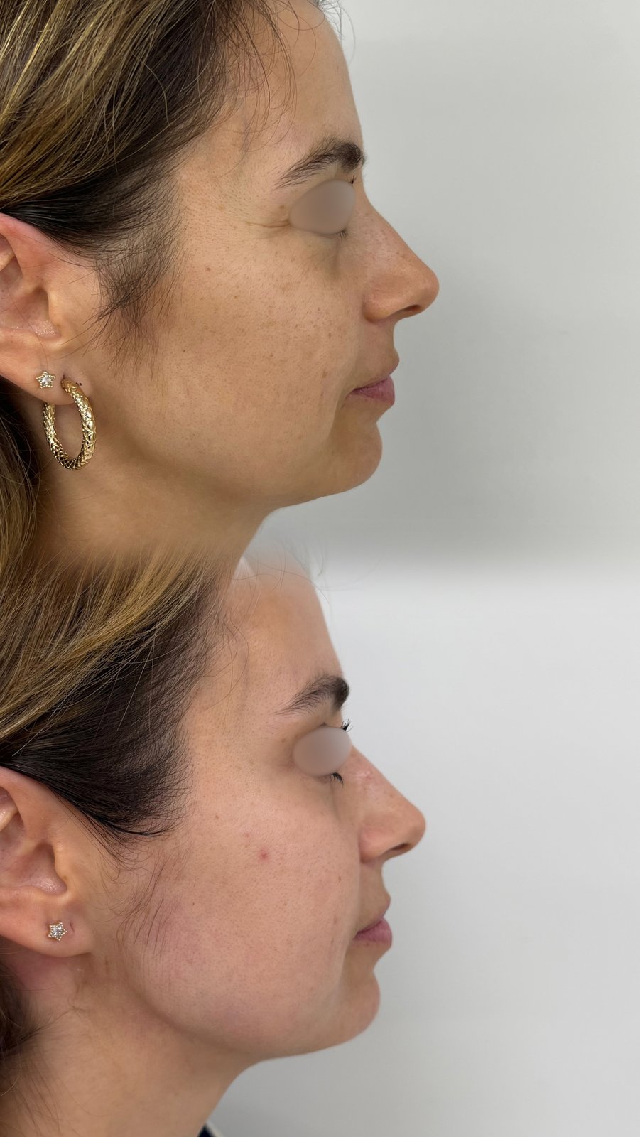 HIFU — antes e depois (caso 27)