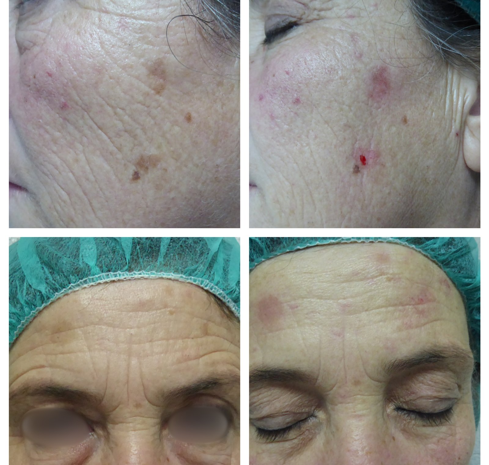 Laser CO₂ — antes e depois (caso 2)