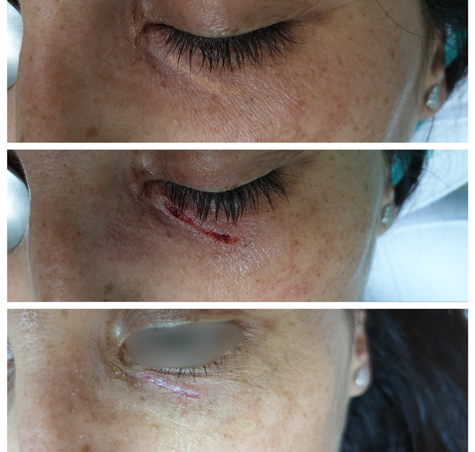 Laser CO₂ — antes e depois (caso 3)