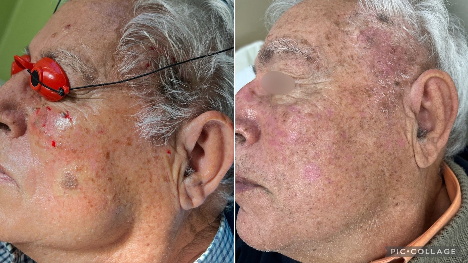 Laser CO₂ — antes e depois (caso 4)