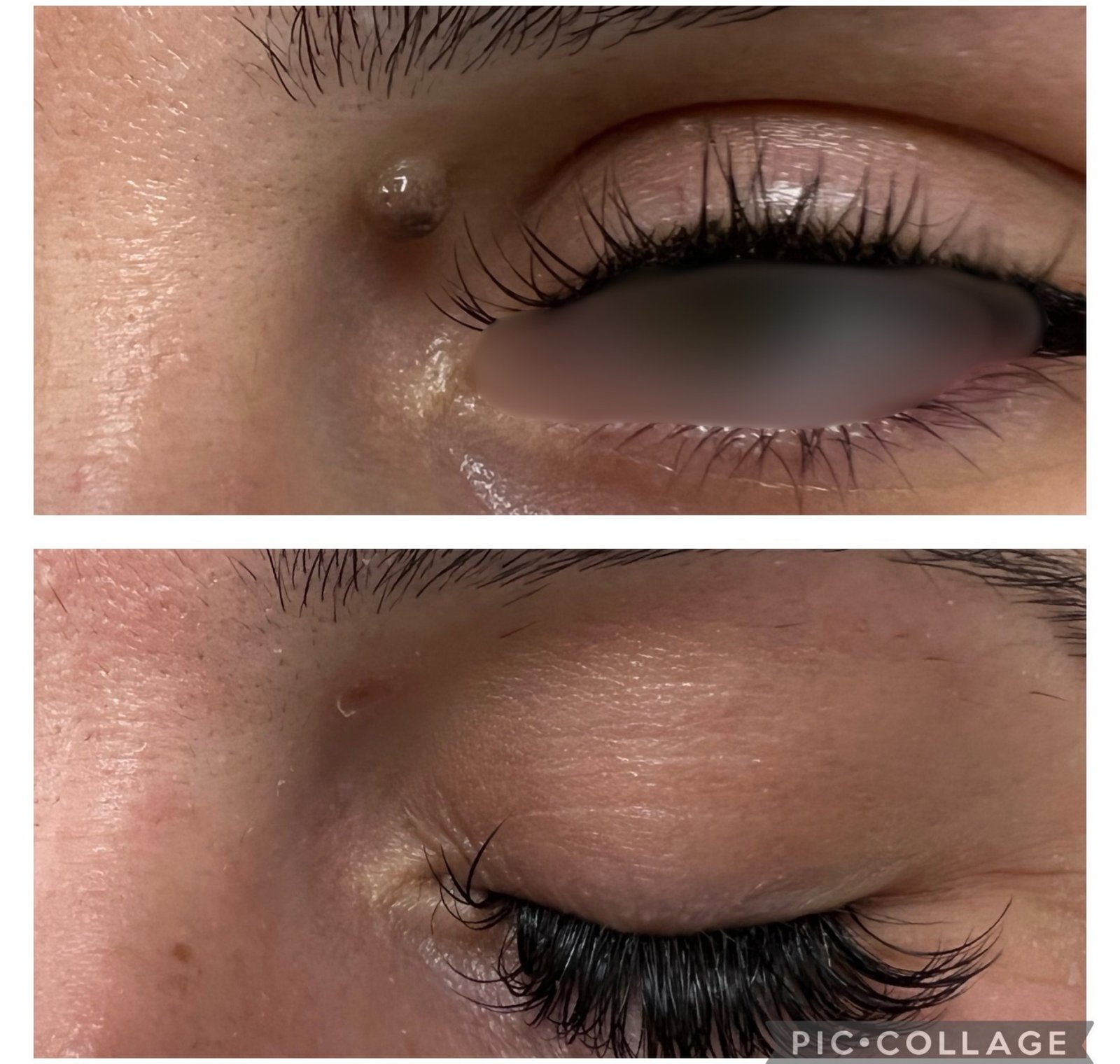 Laser CO₂ — antes e depois (caso 5)