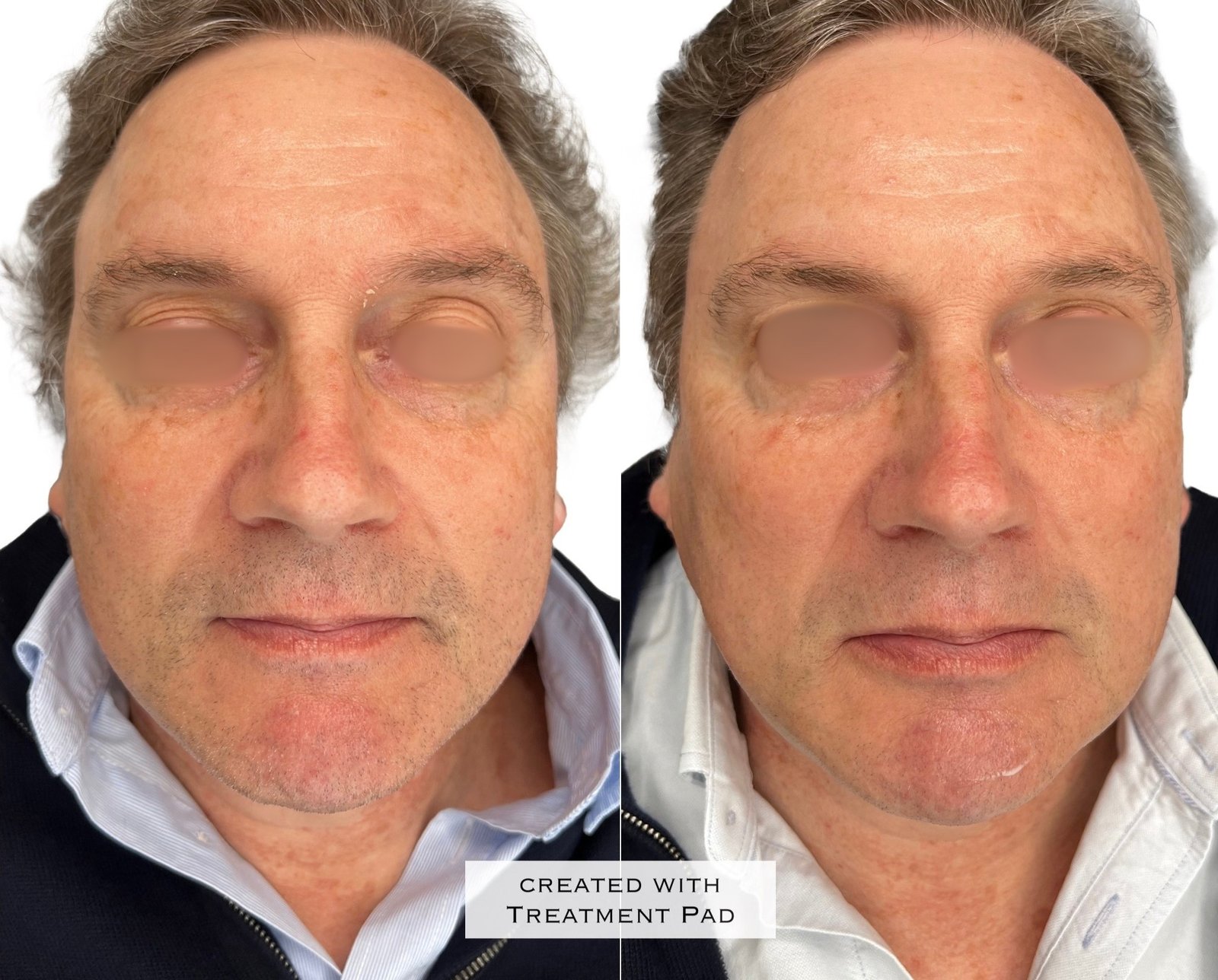 Laser PICO — antes e depois (caso 1)