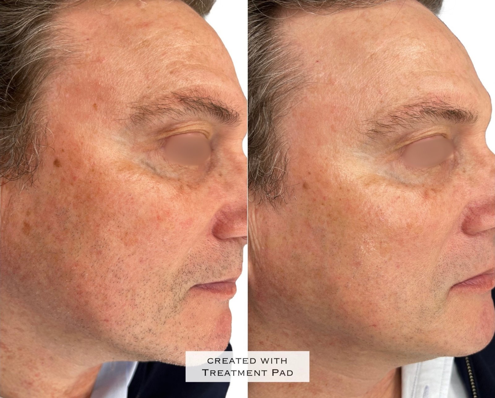 Laser PICO — antes e depois (caso 2)