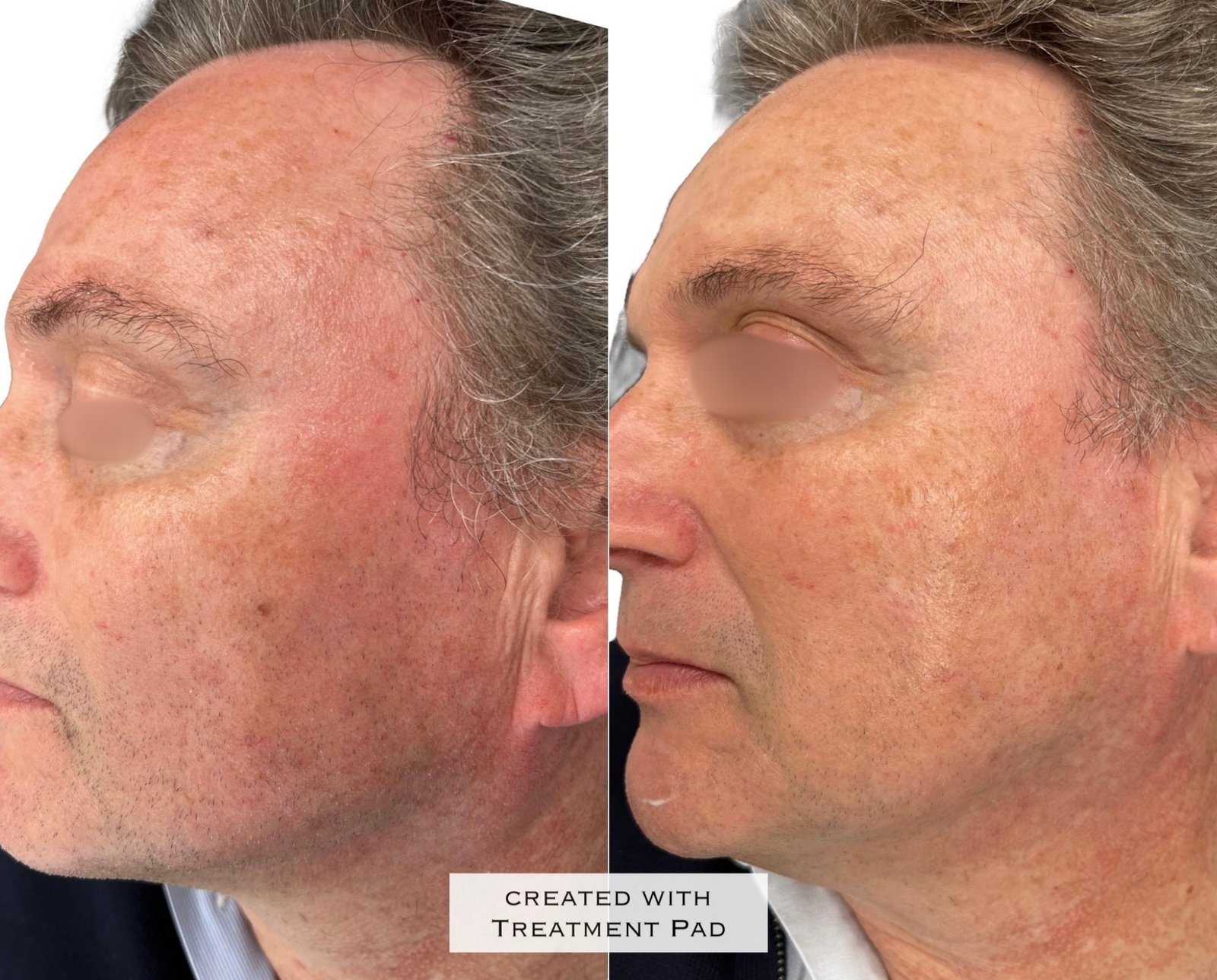 Laser PICO — antes e depois (caso 3)