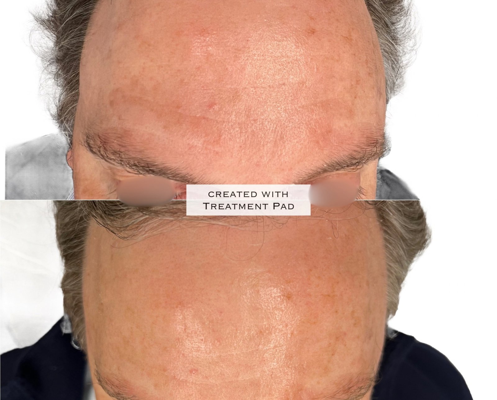 Laser PICO — antes e depois (caso 4)