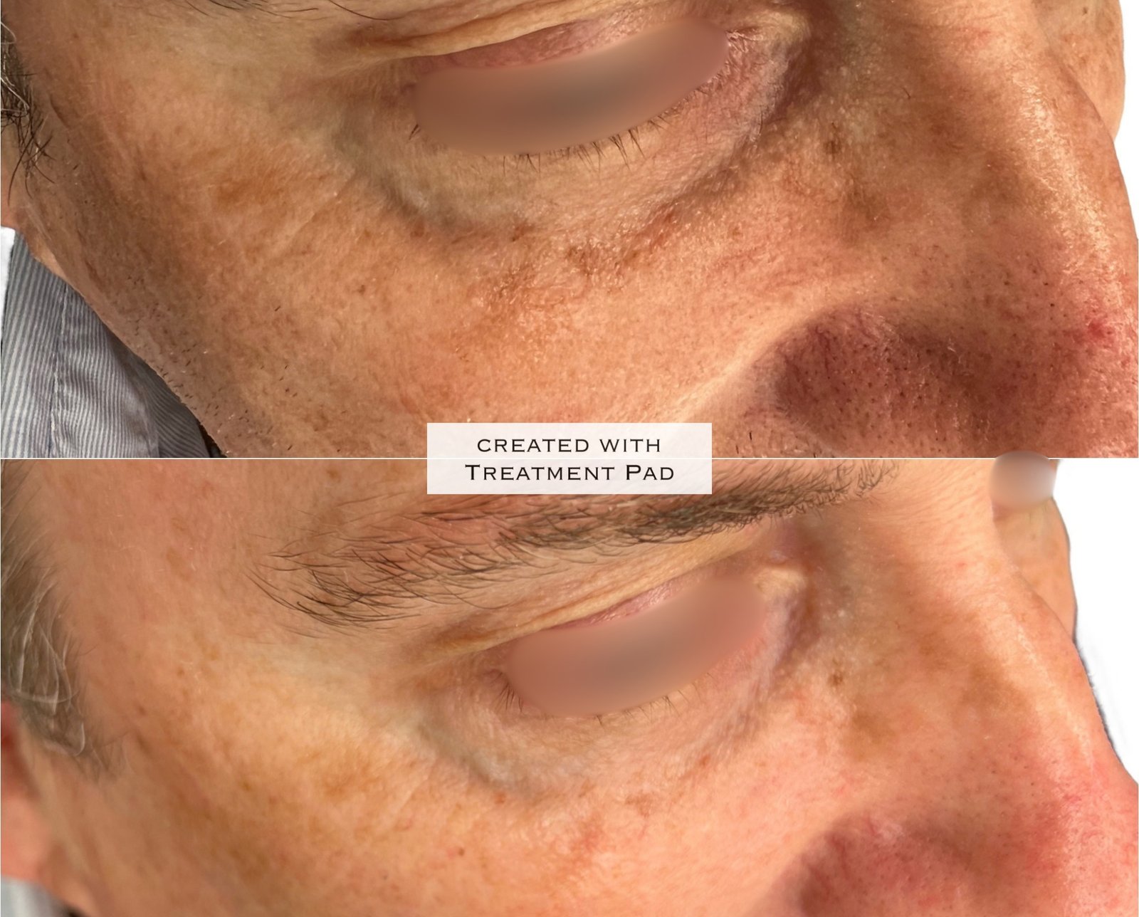 Laser PICO — antes e depois (caso 5)