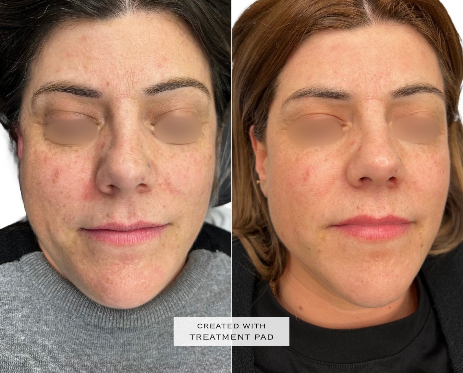 Laser PICO — antes e depois (caso 6)