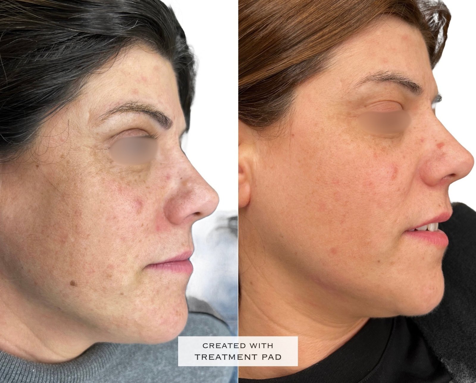 Laser PICO — antes e depois (caso 7)