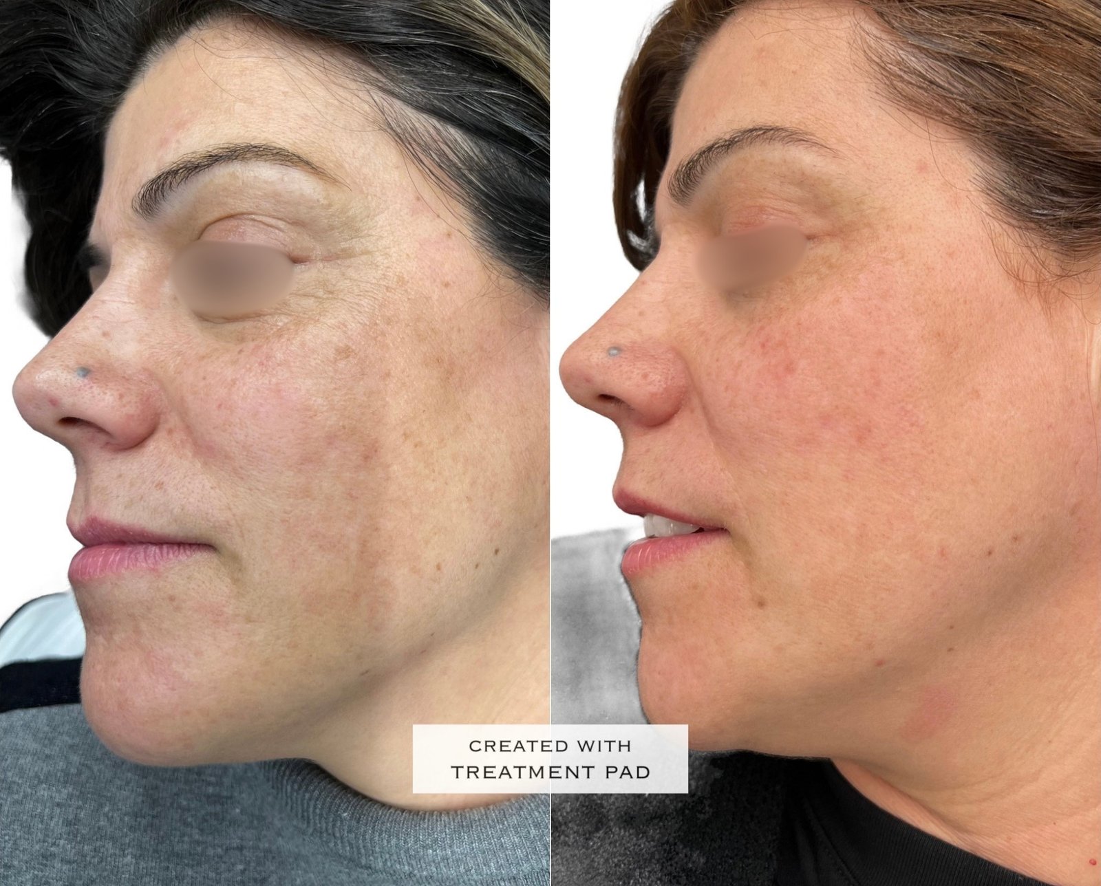 Laser PICO — antes e depois (caso 8)