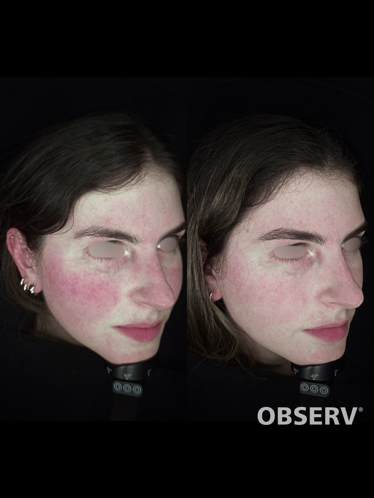 Laser Fotona · Rosácea — antes e depois (caso 1)
