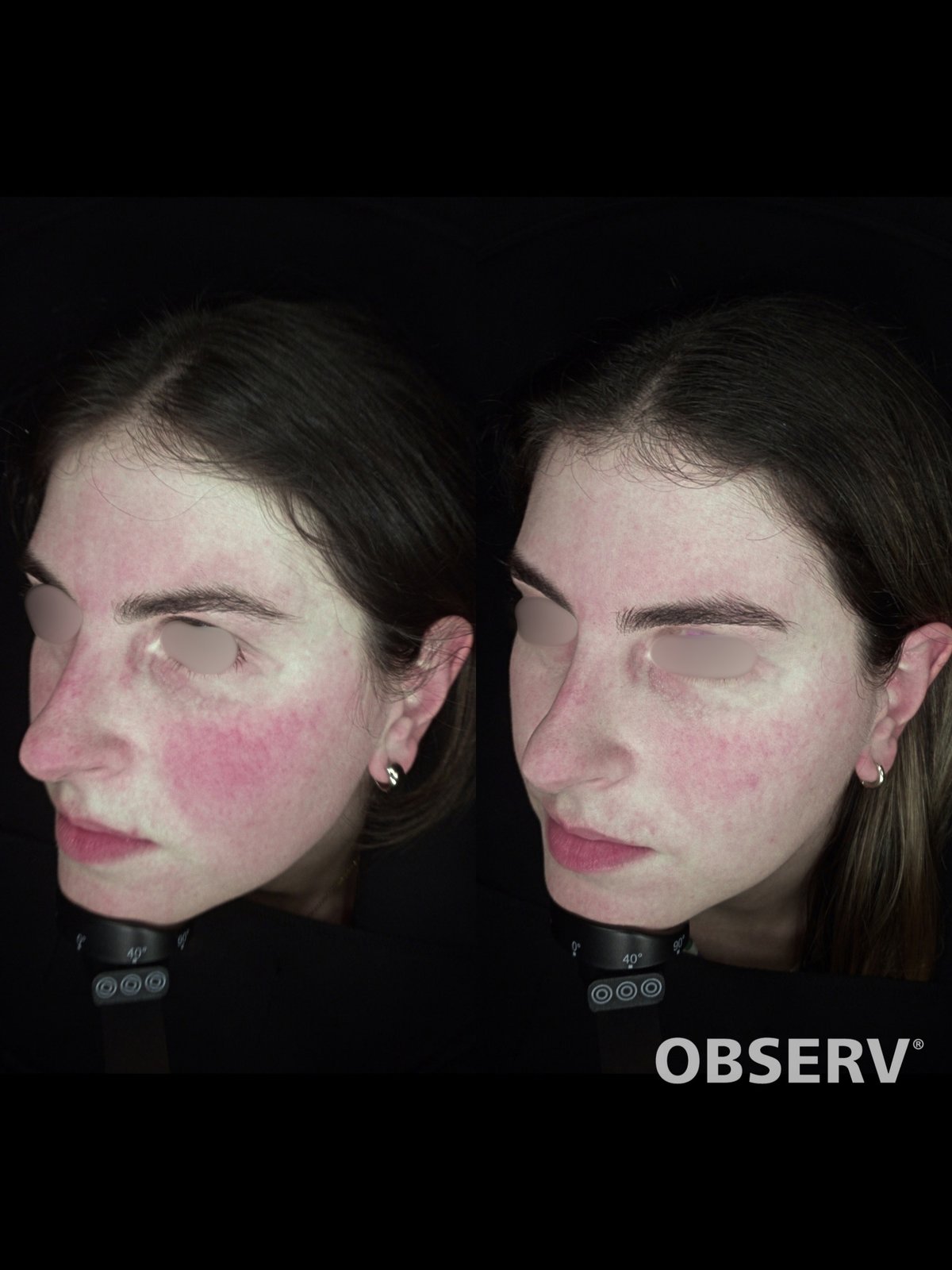 Laser Fotona · Rosácea — antes e depois (caso 2)