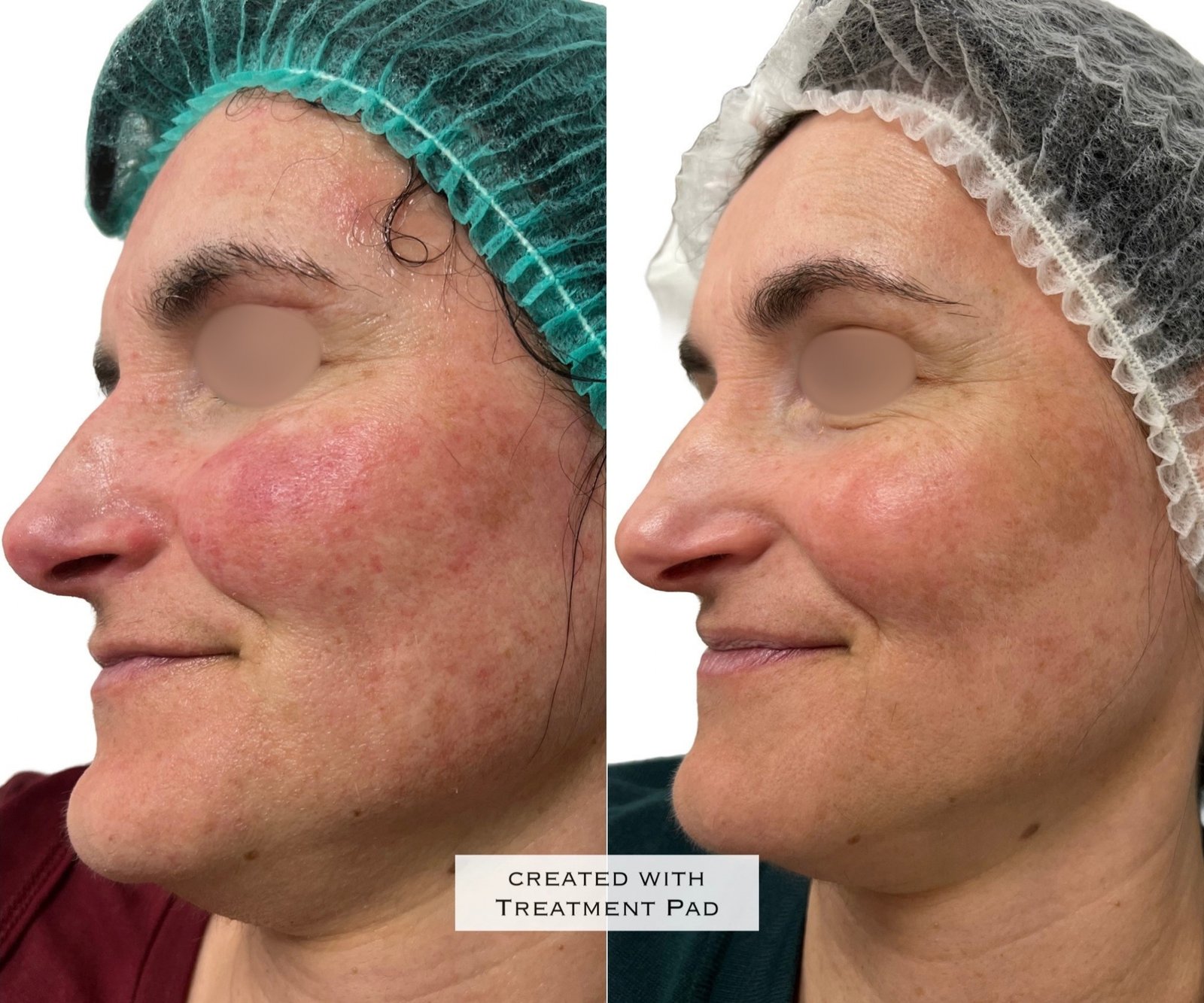 Laser Fotona · Rosácea — antes e depois (caso 3)