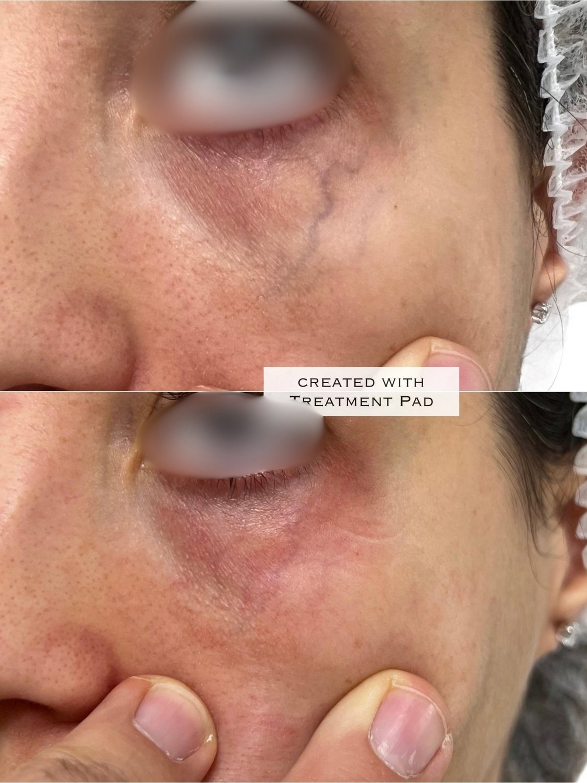 Laser Fotona · Rosácea — antes e depois (caso 4)