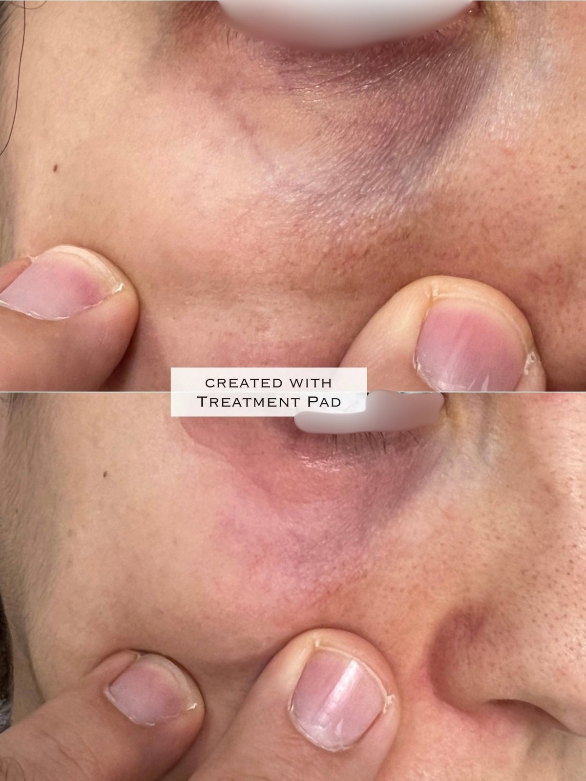 Laser Fotona · Rosácea — antes e depois (caso 5)