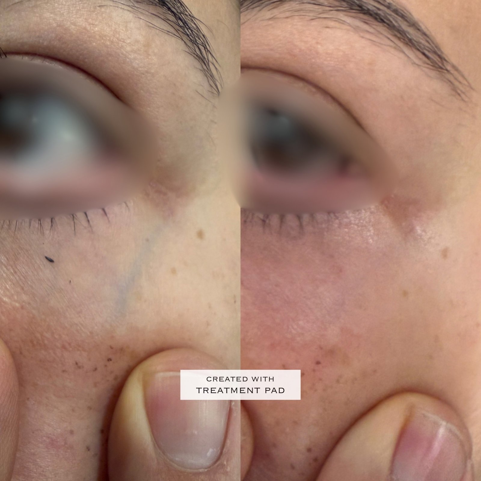 Laser Fotona · Rosácea — antes e depois (caso 6)