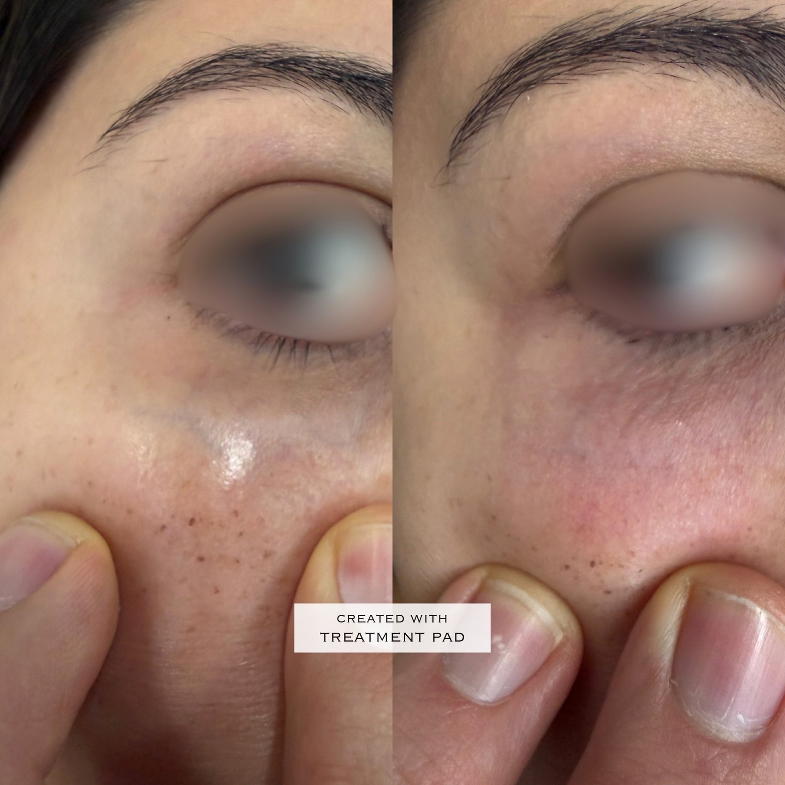 Laser Fotona · Rosácea — antes e depois (caso 7)