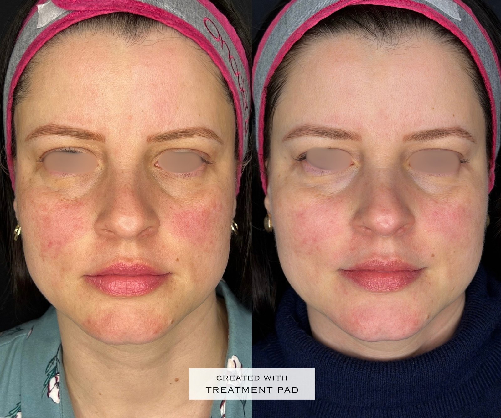 Laser Fotona · Rosácea — antes e depois (caso 8)