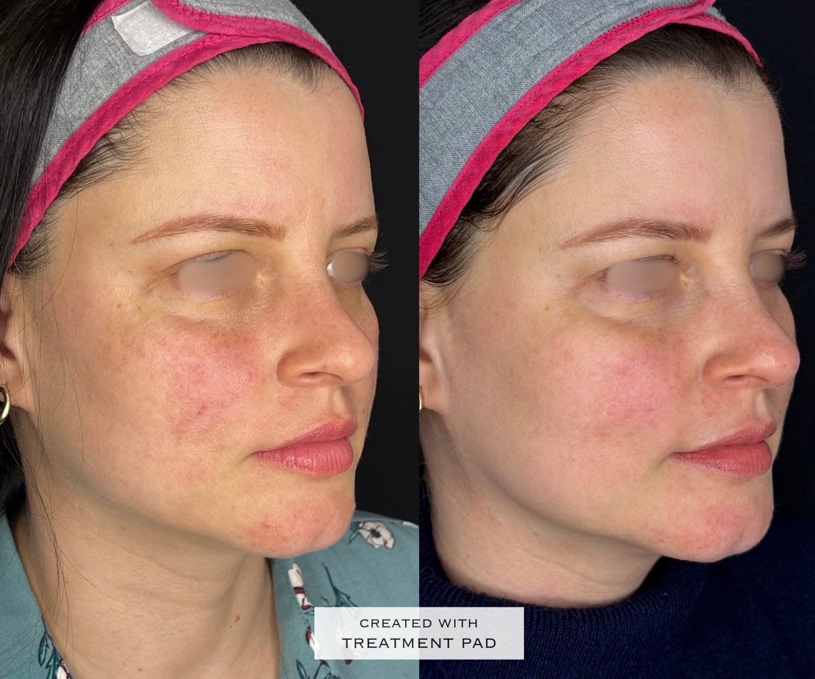 Laser Fotona · Rosácea — antes e depois (caso 9)