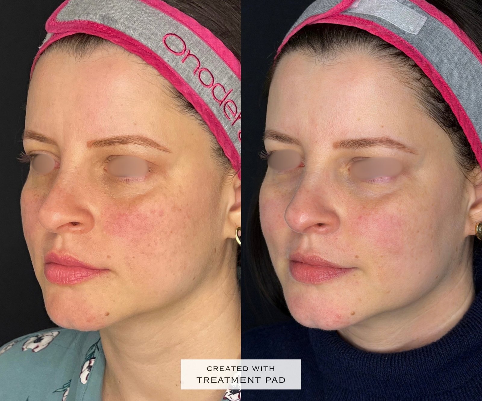 Laser Fotona · Rosácea — antes e depois (caso 10)