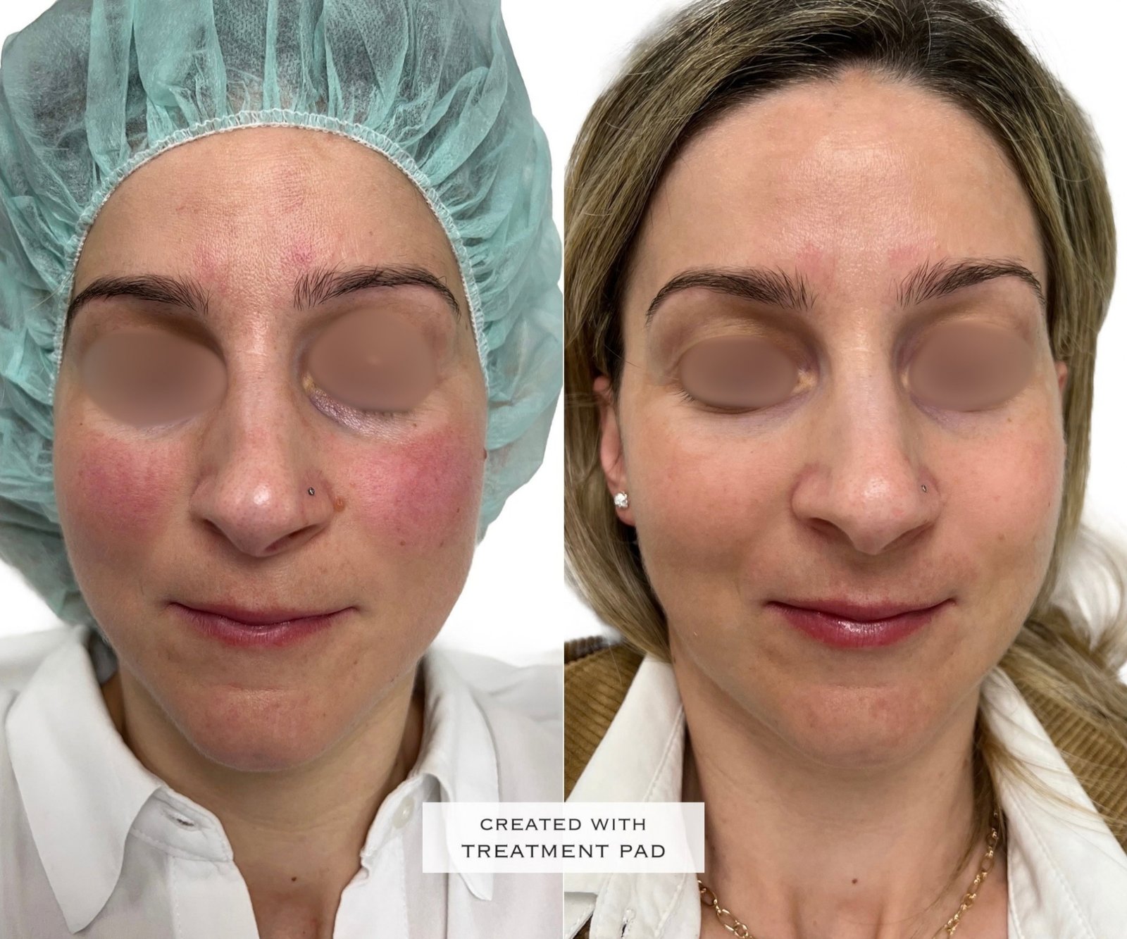 Laser Fotona · Rosácea — antes e depois (caso 11)