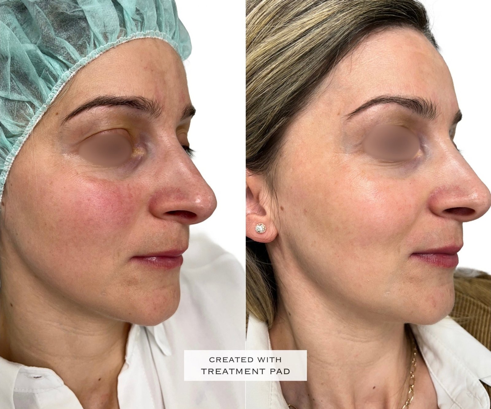 Laser Fotona · Rosácea — antes e depois (caso 12)
