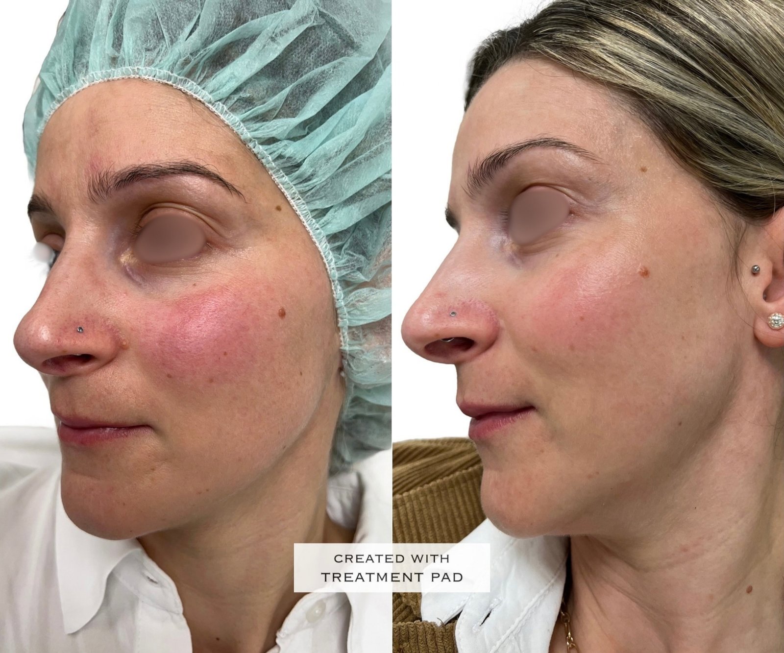 Laser Fotona · Rosácea — antes e depois (caso 13)