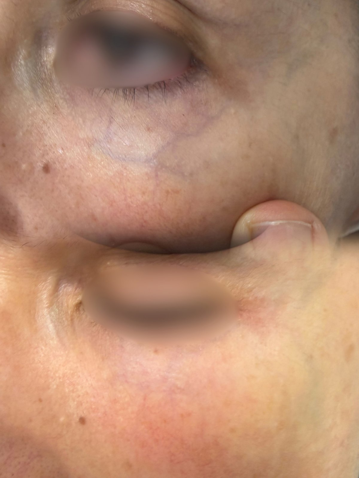 Laser Fotona · Rosácea — antes e depois (caso 14)