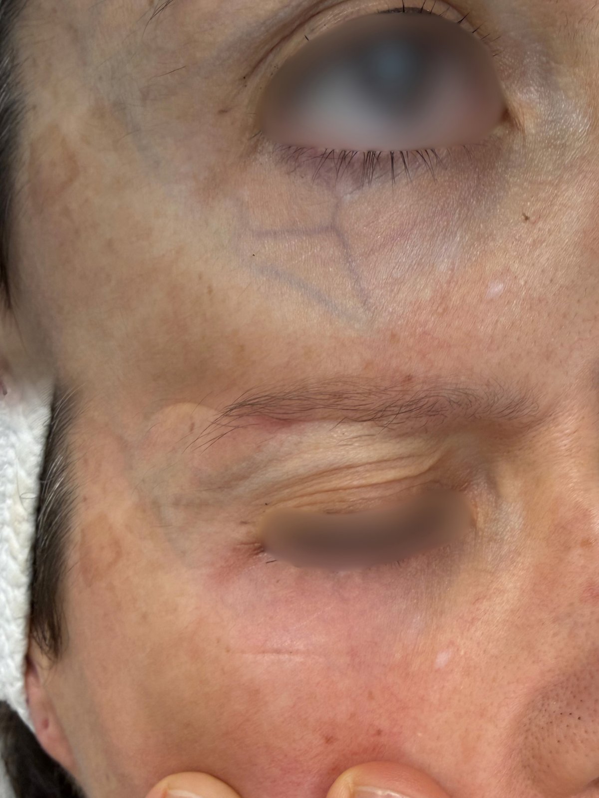 Laser Fotona · Rosácea — antes e depois (caso 15)