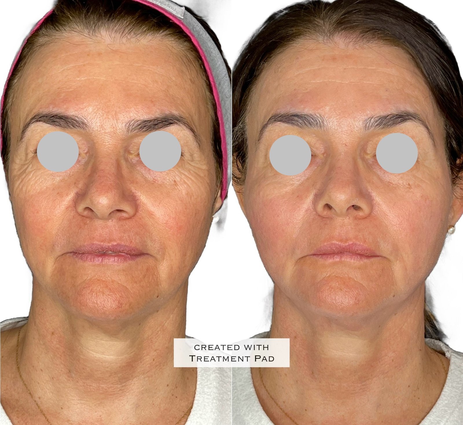 Laser Subdérmico — antes e depois (caso 1)