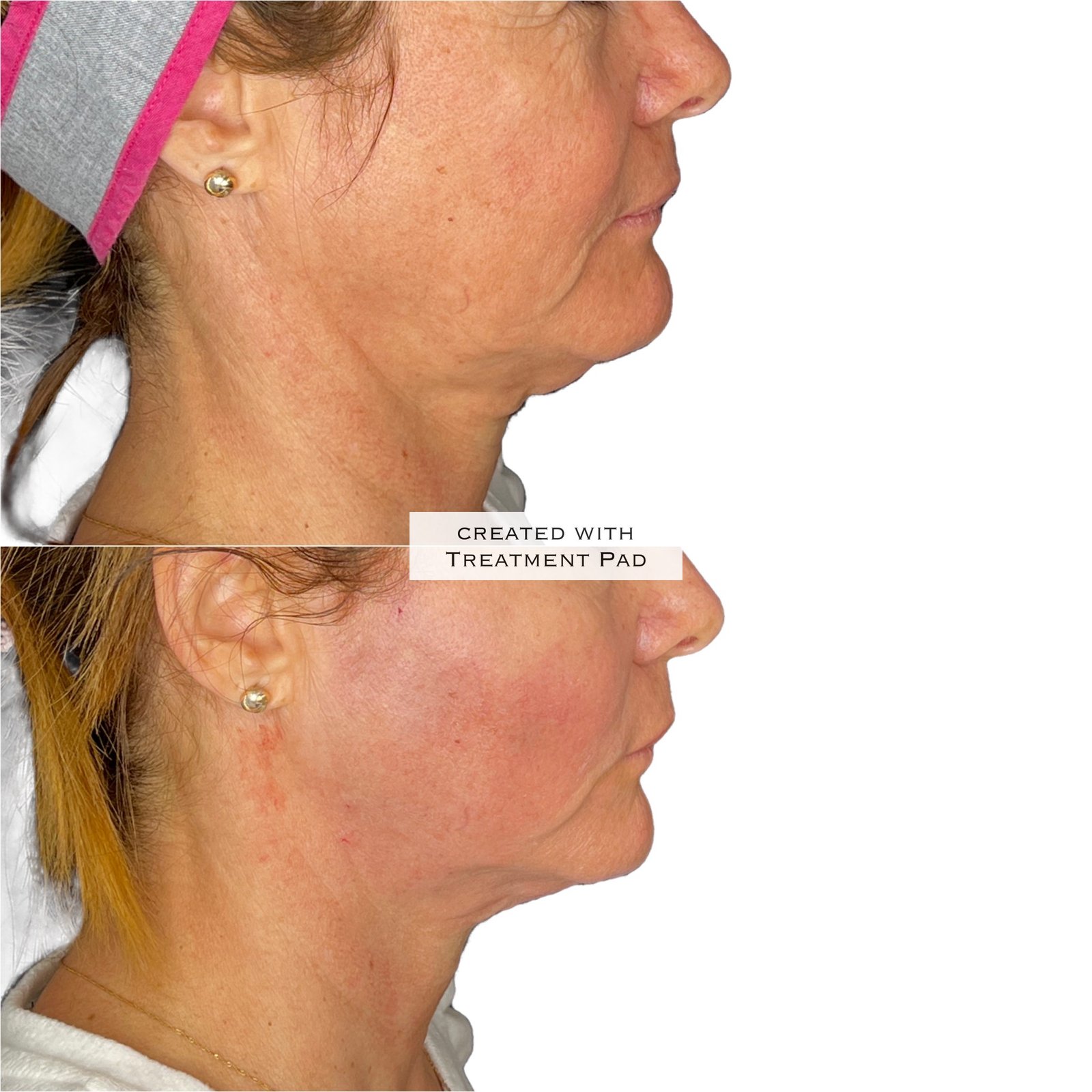 Laser Subdérmico — antes e depois (caso 2)