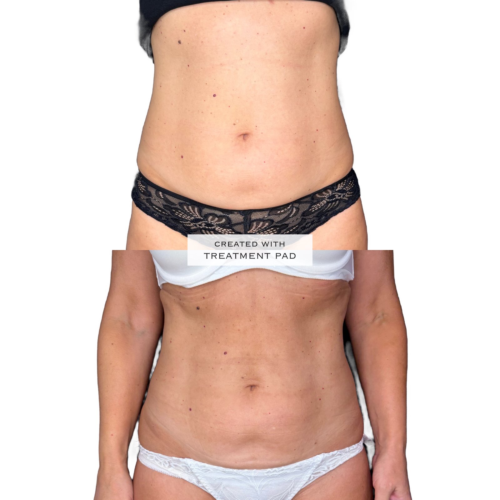 Laser Subdérmico — antes e depois (caso 3)