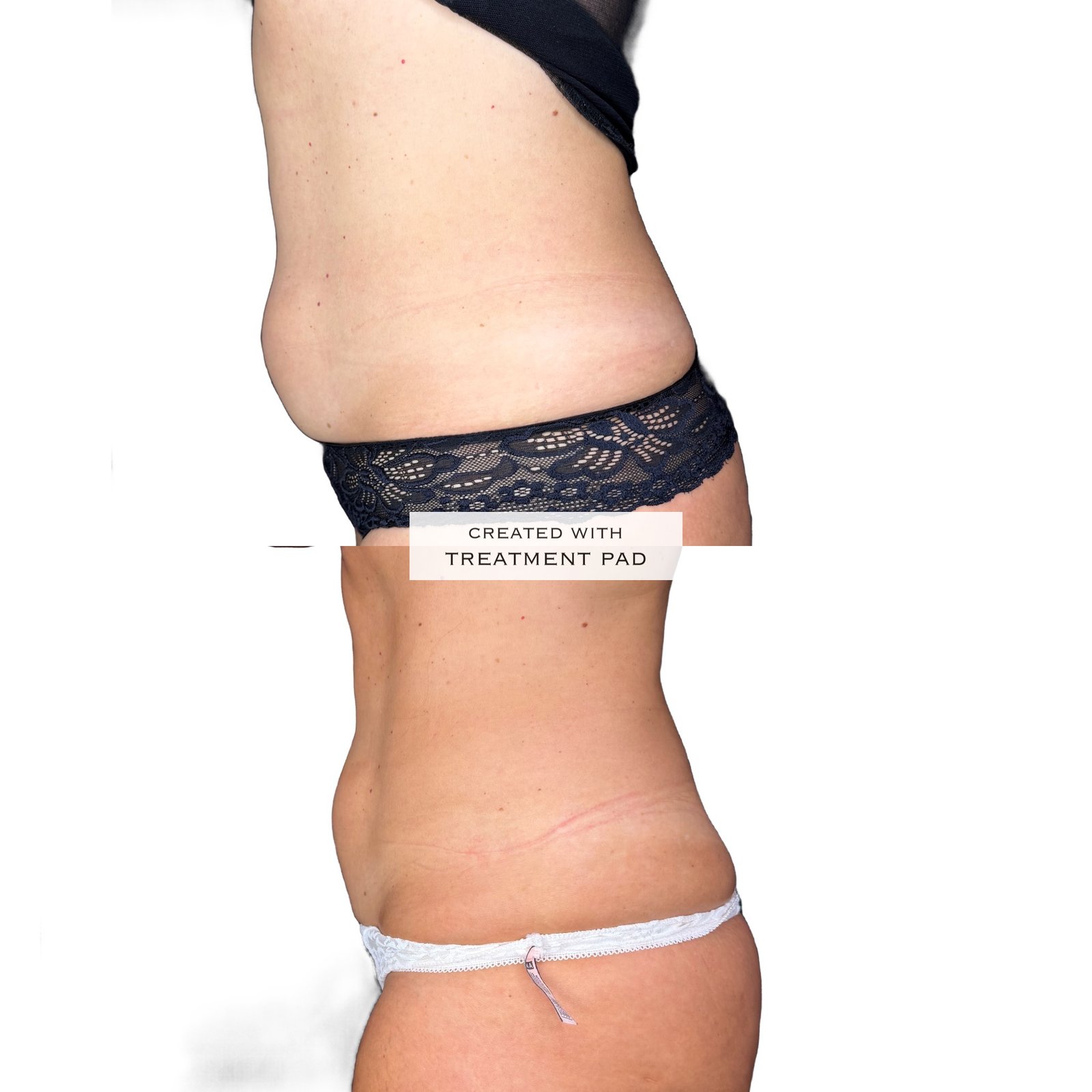 Laser Subdérmico — antes e depois (caso 4)