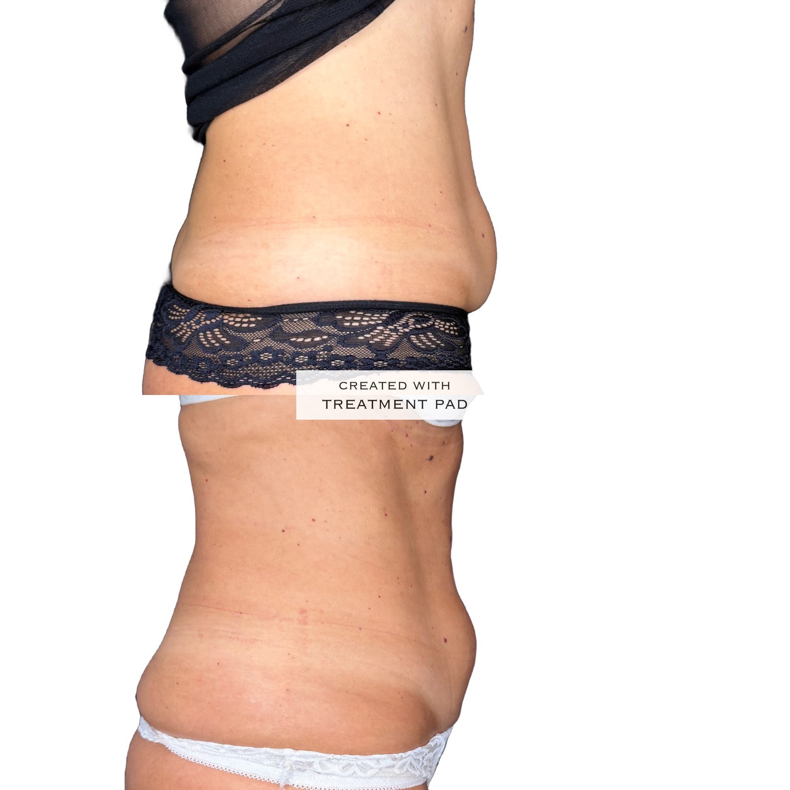Laser Subdérmico — antes e depois (caso 5)